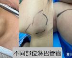 淋巴瘤的形成原因