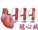 慢性炎症是冠心病的主要推手