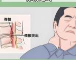 脊髓型脊椎病早期表现