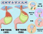胃食管反流可能“伤全身”
