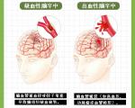 大脑“短暂停机”，警惕是中风前的血管预警