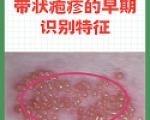 带状疱疹的早期识别特征