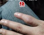 痛风发作应急口诀是什么？