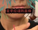 夏日吹空调，谨防面瘫（面神经炎）
