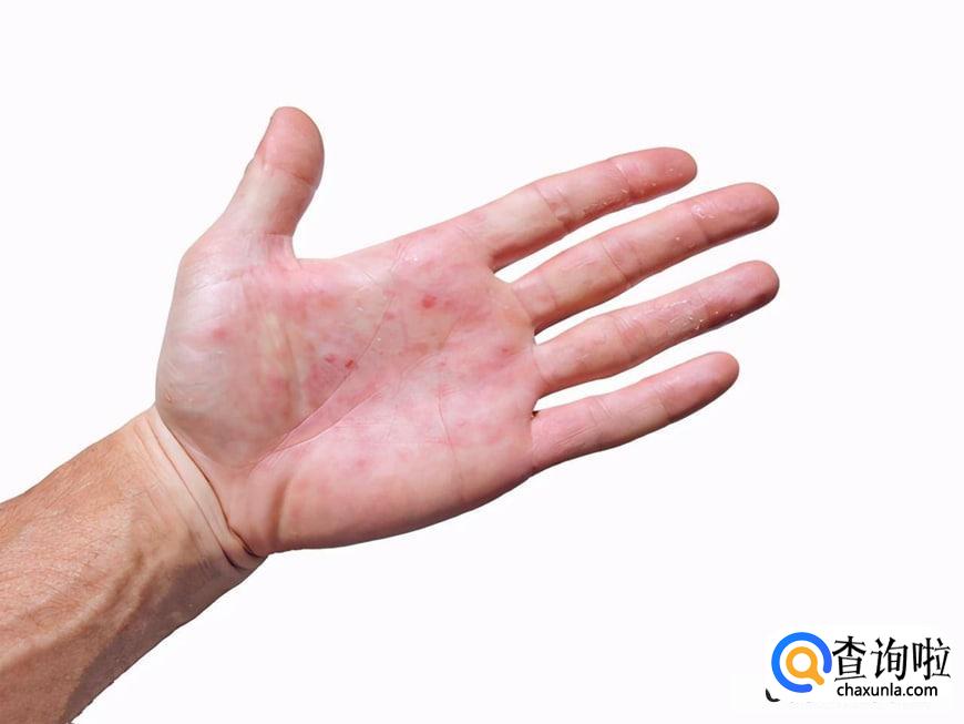 手经常蜕皮的原因
