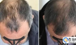 头发稀疏怎么改善（通过药物）