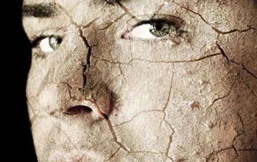 如何治疗干燥综合症