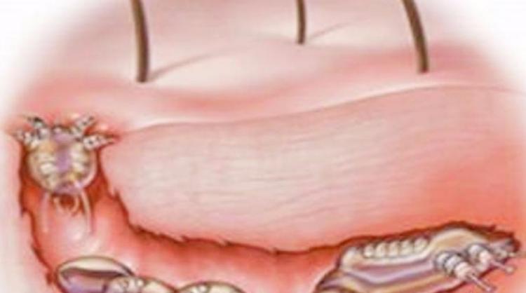 疥疮的最佳治疗方法