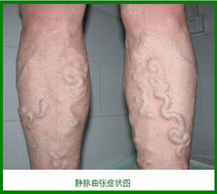 静脉曲张怎么治疗？最好的方法有哪些？