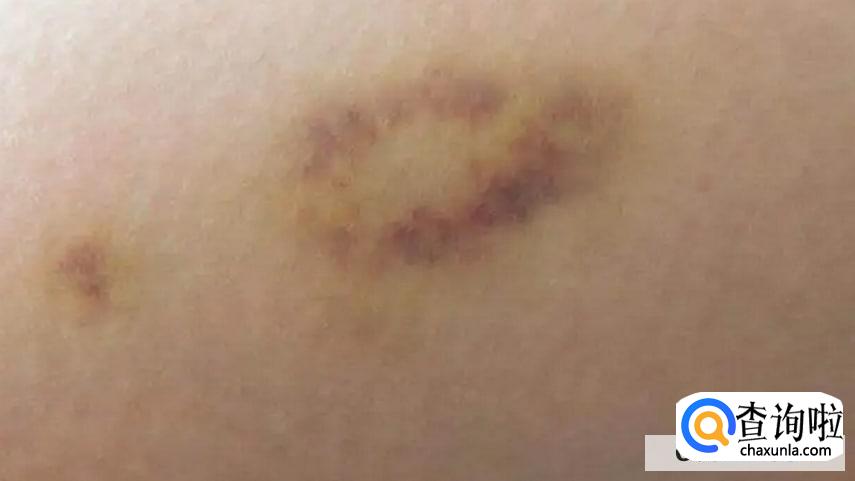 身上总是青一块紫一块什么原因