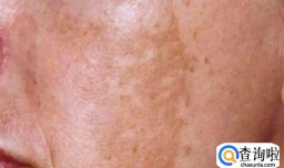 为什么长老年斑