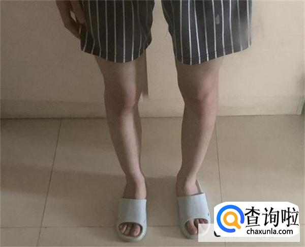 o型腿可以跑步吗