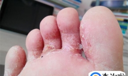脚上起小水泡怎么根治