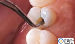 牙齿烂个洞露出牙神经痛怎么办