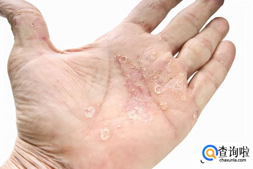 手蜕皮是怎么回事