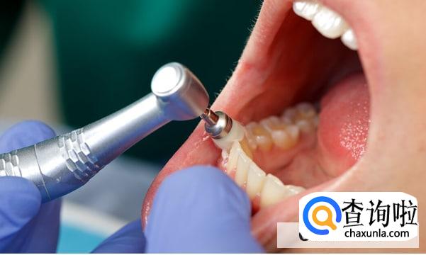 这4类人千万别洗牙▁洗牙的好处与坏处