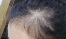 长头发掉发严重怎么办
