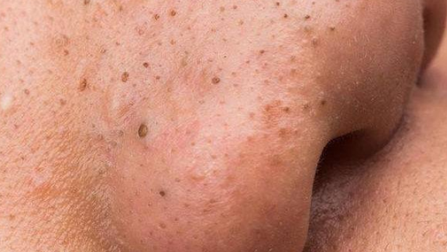 鼻子黑毛跟黑头的区别