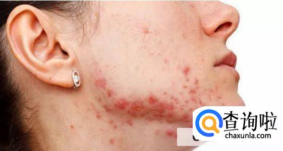 安全有效的祛痘方法