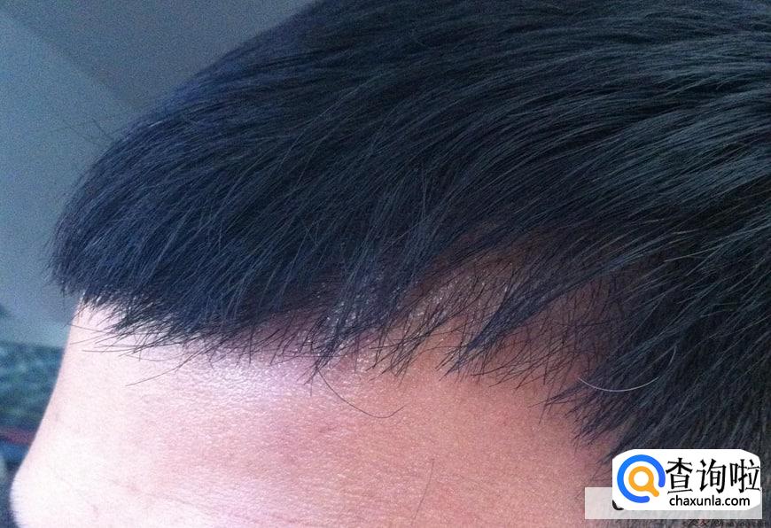 植发能不能一劳永逸