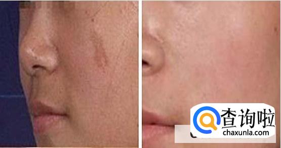 脸上胎记激光可以做吗