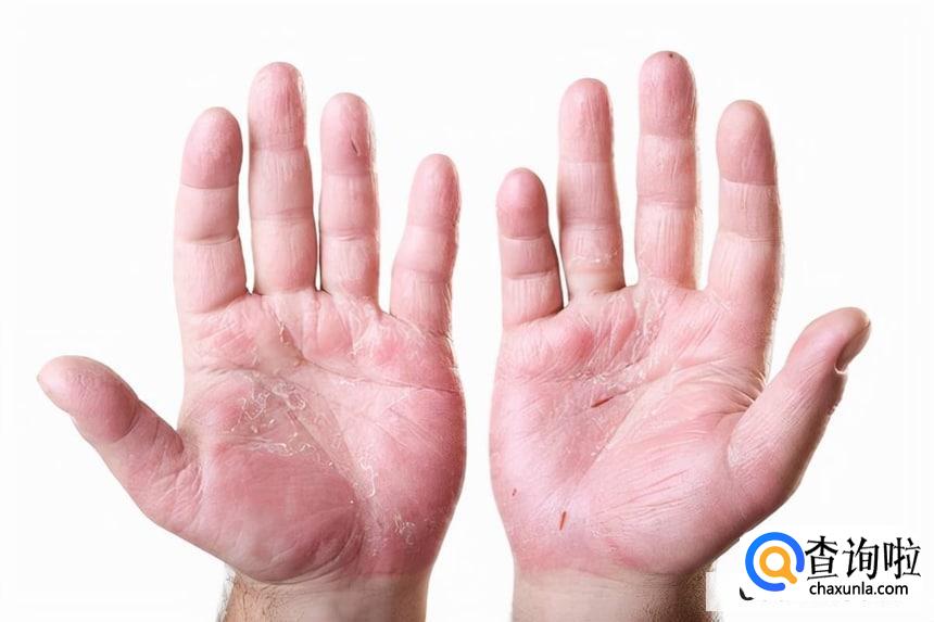 手经常蜕皮的原因