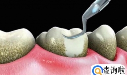 洗牙对牙齿好不好