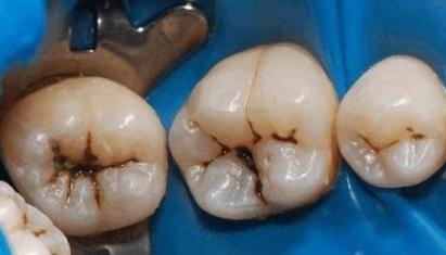 口臭的原因和治疗方法