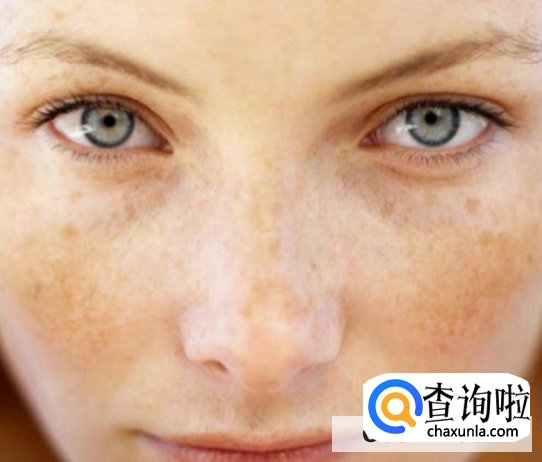 女性脸上长斑的5大原因
