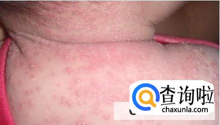 处理新生儿湿疹小妙招