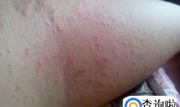 湿疹的人穿过的衣服还可以穿吗