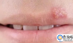 无缘无故会得疱疹吗