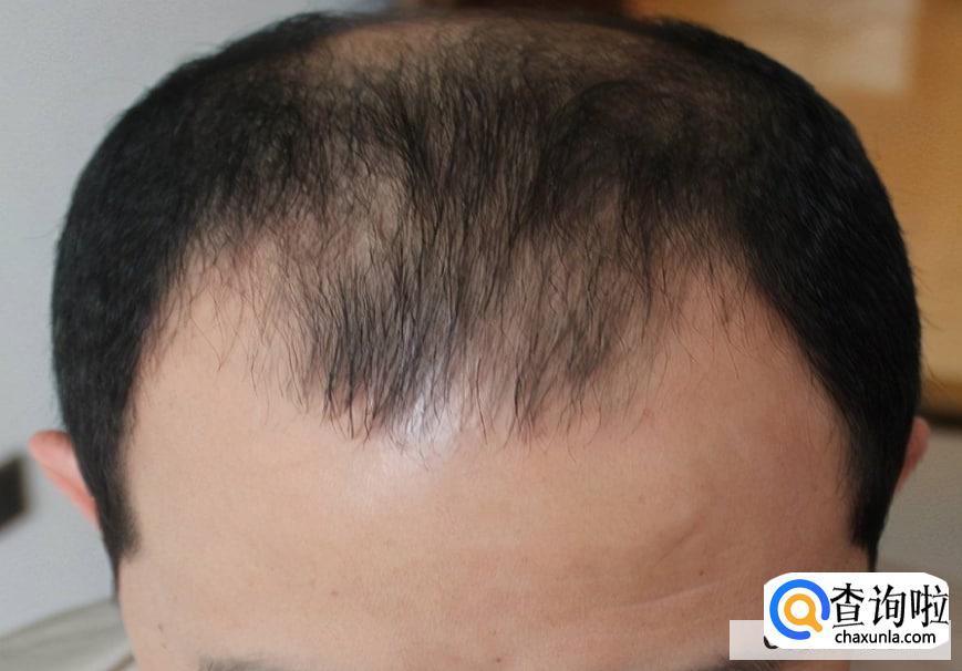男性脱发厉害怎么办