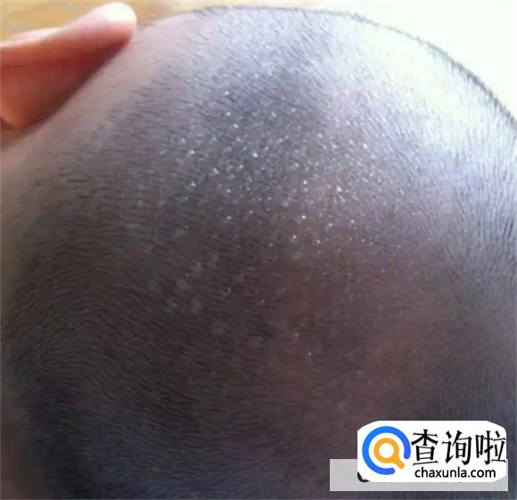 孩子9岁会出现睡觉头上疯狂的冒汗吗