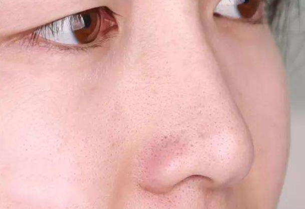 鼻子黑毛跟黑头的区别