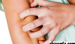 被虫子咬了手肿了怎么办