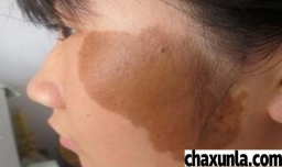 激光可以祛胎记吗