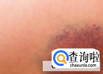 身上无缘无故出现淤青是什么原因
