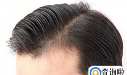 种发际线多少钱