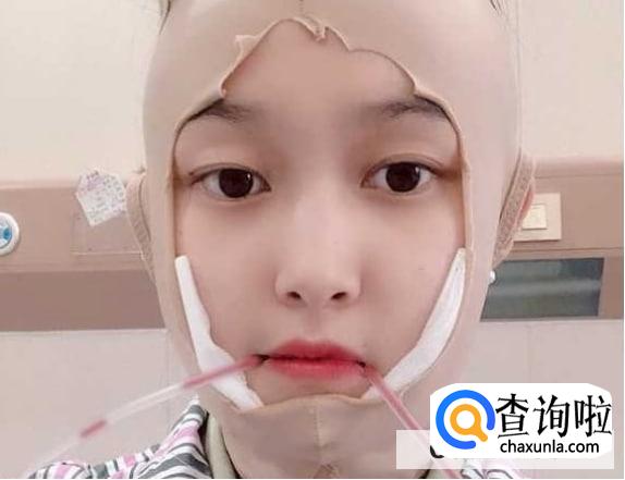 下颌角手术头套带多久