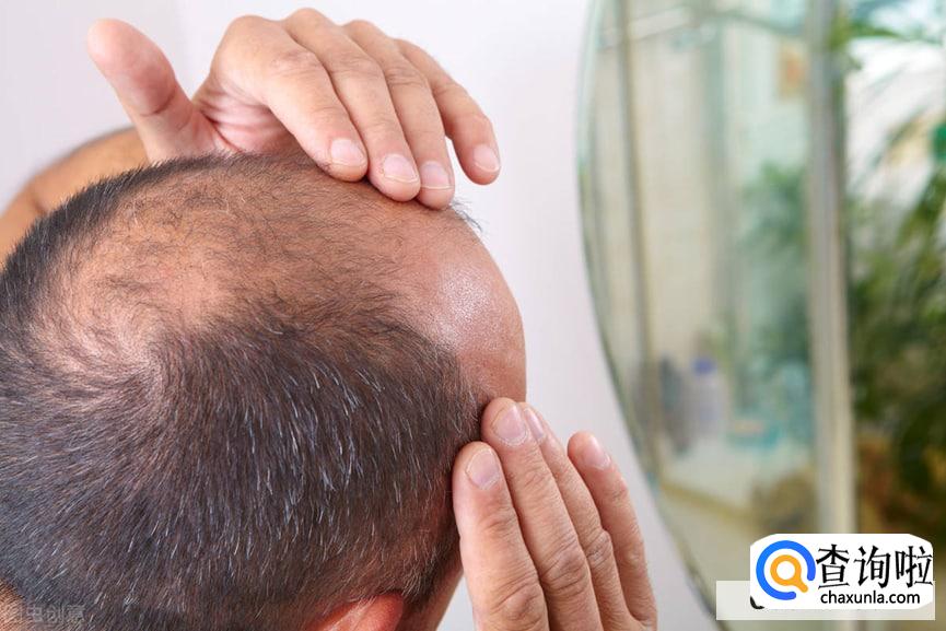 男性脱发厉害怎么办