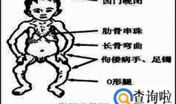佝偻病与软骨病的区别