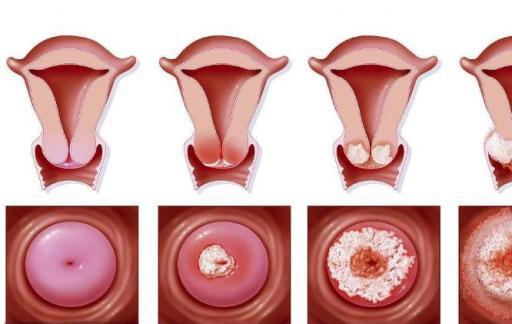 如何正确认识宫颈炎