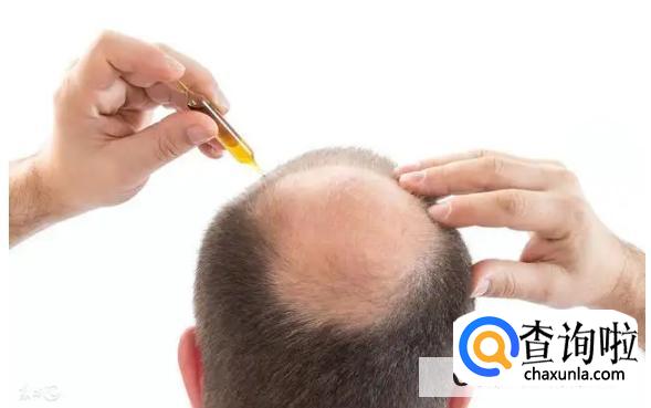 如何预防脱发