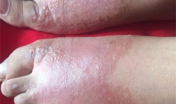 夏天脚上起水泡怎么办