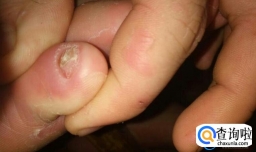 脚趾甲长黑斑的原因