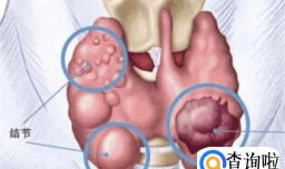 甲状腺结节是什么病