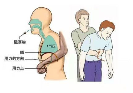 被噎到无法呼吸了怎么办？