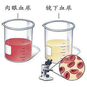 尿血怎么回事