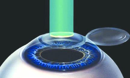 如何治疗近视眼